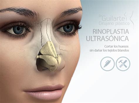 ¿qué Es Y En Qué Consiste La Rinoplastia Ultrasónica Clinica Dr Guilarte