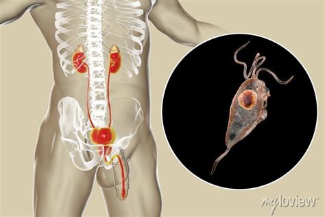 Tricomoniase Fotos No Homem - Infecção por tricomoníase no homem, ilustração 3d mostrando o ...