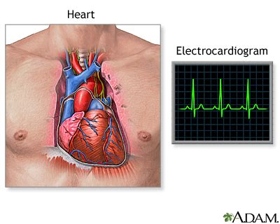 Ectopic heartbeat: MedlinePlus Medical Encyclopedia