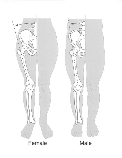 Females have a wider pelvis than males and a larger Q-angle at the knee