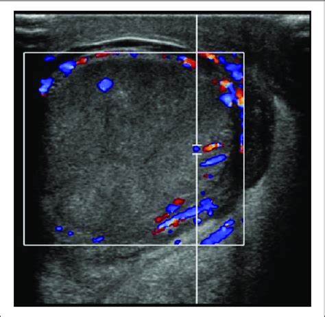 Testis Ultrasound