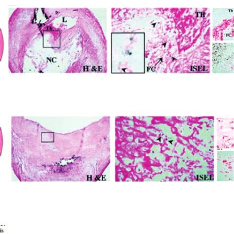 Noninvasive Imaging Of Vulnerable Carotid Artery Atherosclerotic Lesion Download Scientific