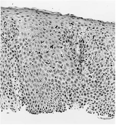 Figure 1 From Multiple Esophageal Rings An Association With