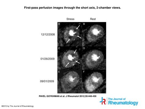 First Pass Perfusion Images Through The Short Axis 2 Chamber Views