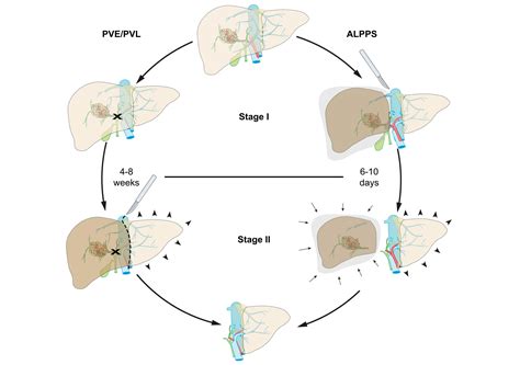 Liver Resection And Transplantation For Intrahepatic Cholangiocarcinoma Journal Of Hepatology