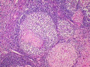 Chronic Granulomatous Disease - MyBioSource Learning Center