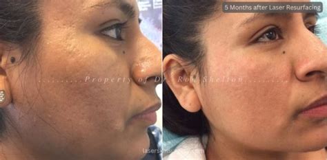 Laser Skin Resurfacing Before And After Photo Gallery New York City