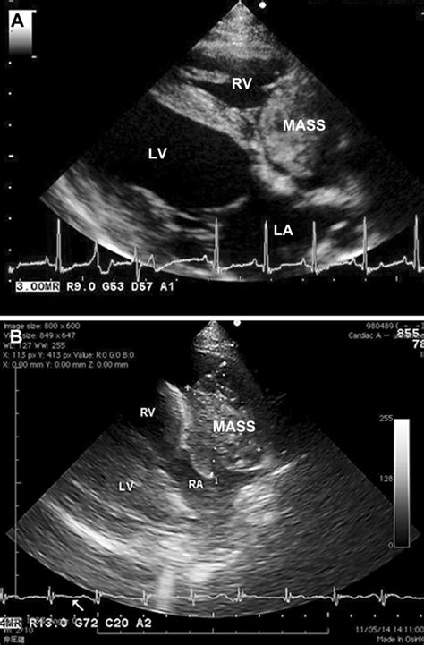 Two Dimensional Echocardiograms Long Axis View From The Right