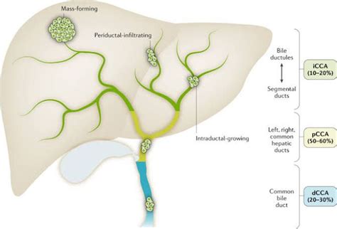 Cholangiocarcinoma symptoms - MEDizzy