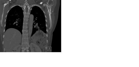 13 questions with answers in Splenectomy | Scientific method