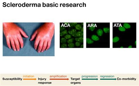 Scleroderma The Key Scientific Questions Institute Of Immunity And