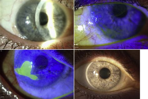 Limbal Stem Cell Transplantation For Soft Contact Lens Wearrelated