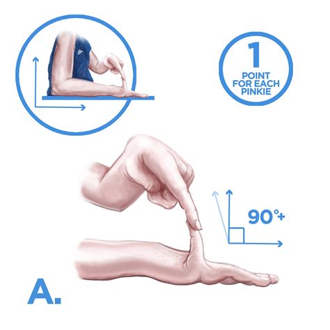 Medición De Hiperlaxitud Articular The Ehlers Danlos Society