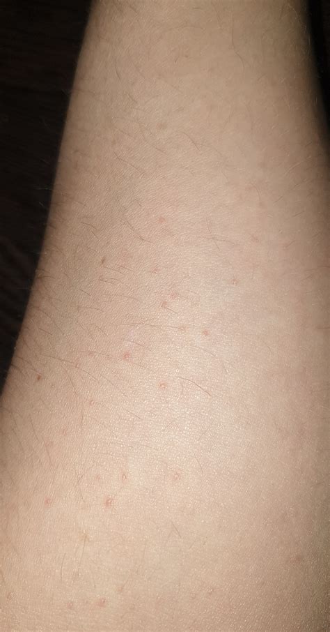 Мелкая сыпь на теле - Вопрос дерматологу - 03 Онлайн