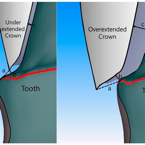 Schematic Showing Measurement Positions For Marginal And Internal Fit