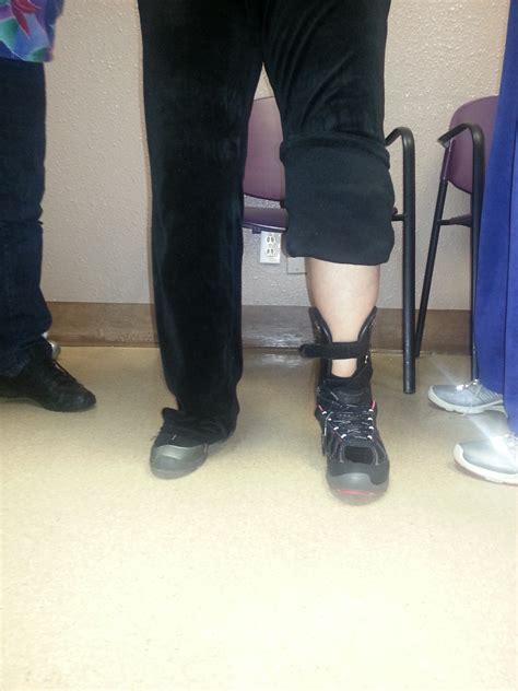 ankle dislocation front richie brace - Foot Doctor San Diego / La Jolla ...