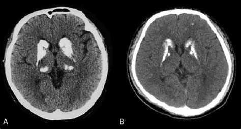 Basal Ganglia Anatomy Ct