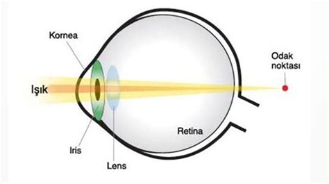 Lazerle Hipermetrop Tedavisi Ve Hipermetrop Nedir