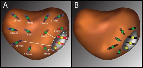 Targeted Prostate Biopsy Umbra Penumbra And Value Of Perilesional