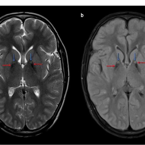 Axial Brain Magnetic Resonance Imaging MRI Weighted In T2 A And T2