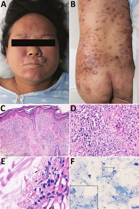 Figure Clinical Features Of Mycobacterium Leprae Infection In Pregnant Download Scientific