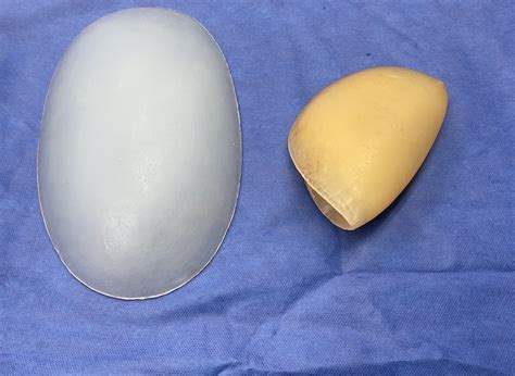 Plastic Surgery Case Study Custom Hip Implant Replacements For Folded