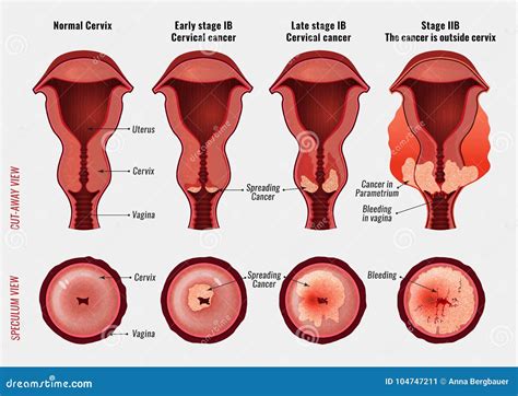 Cervical Cancer Image Stock Vector Illustration Of Healthcare 104747211