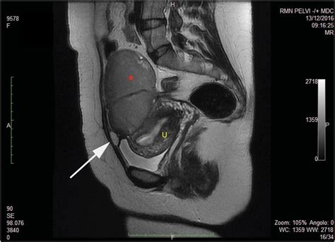 Intra Operative Image Of Urachal Cyst Red Star Urachal Cyst Rs