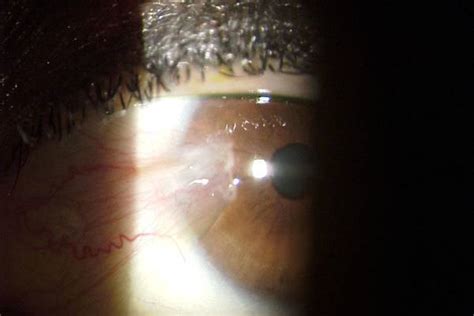 Pterygium Treatment & Surgery at NeoVision in Union City