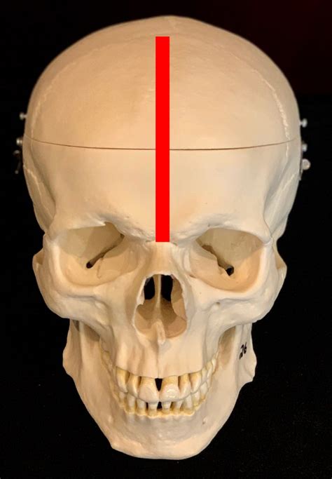 Metopic Suture