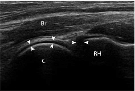 Quick Guide to Diagnostic Ultrasound of the Elbow - Sports Medicine Review