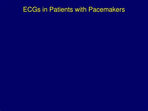 Ppt Ecg In Pacemaker Malfunction Powerpoint Presentation Free