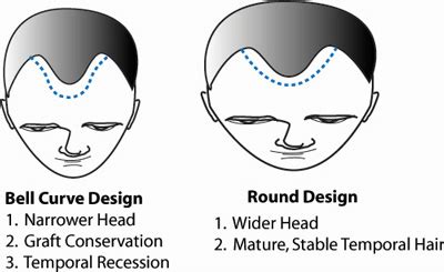 Hairline Design Dallas Hair Transplant Shape Information Plano TX