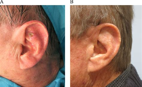 Preauricular Pull Through Flap For Reconstruction Of The Auricle