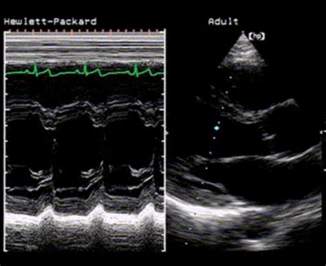 Unit 2 Normal Transthoracic Echocardiogram M Mode And Doppler Flashcards