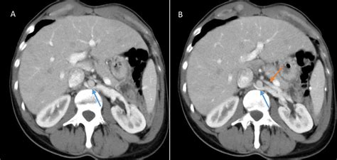 Axial Oblique Ct With Contrast Demonstrates The Circumaortic Left