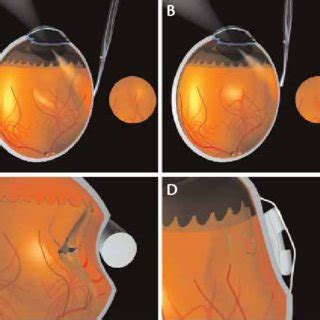 (PDF) Complications of Scleral Buckling