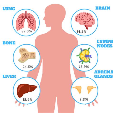 Most common sites of metastases in RCC. | Download Scientific Diagram