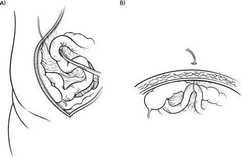 Loop Ileostomy Closure