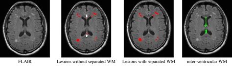 Figure 1 From Multiple Sclerosis Lesion Segmentation Using Statistical And Topological Atlases