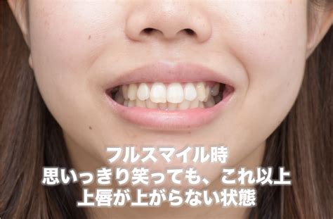 笑うと10mmの歯茎の露出がある重度ガミースマイルを治療した症例（上唇粘膜切除術）｜天王寺区（四天王寺前夕陽ヶ丘）の歯医者「ヤスデンタルクリニック」