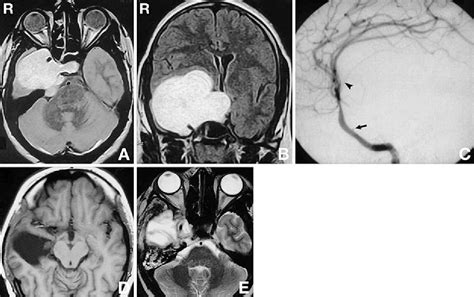 Figure From Extradural Approach For Cavernous Hemangioma Of The