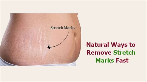 11 Natural Ways To Remove Stretch Marks Fast