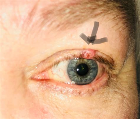 Eyelid Cancer Treatment in 2018