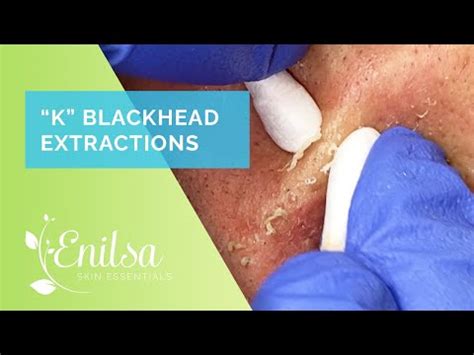 blackheadsextraction enilsa brown 2021