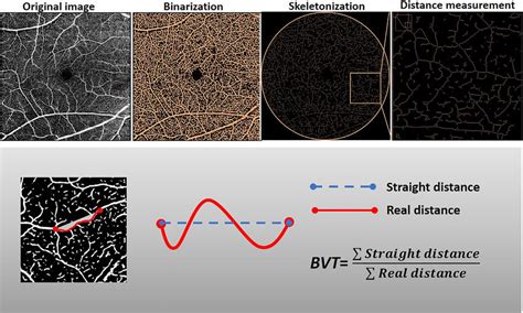 Schematic Illustration Of The Retinal Microvascular Bvt Measurement And