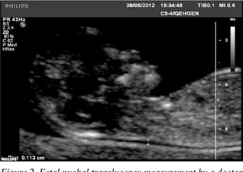 Figure 1 From Fetal Nuchal Translucency Measurements Performance Of