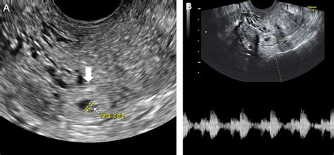 Magnetic Resonance Imaging In Tubal And Non Tubal Ectopic Pregnancy