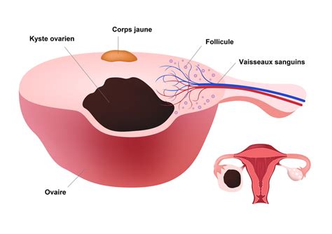 Kyste ovarien symptômes cause ventre gonflé dangereux