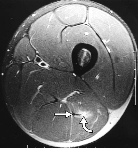 Hamstring Muscle Complex An Imaging Review Radiographics